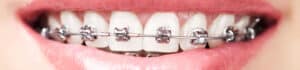 METAL BRACES 2