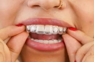 διαφανείς νάρθηκες Invisalign