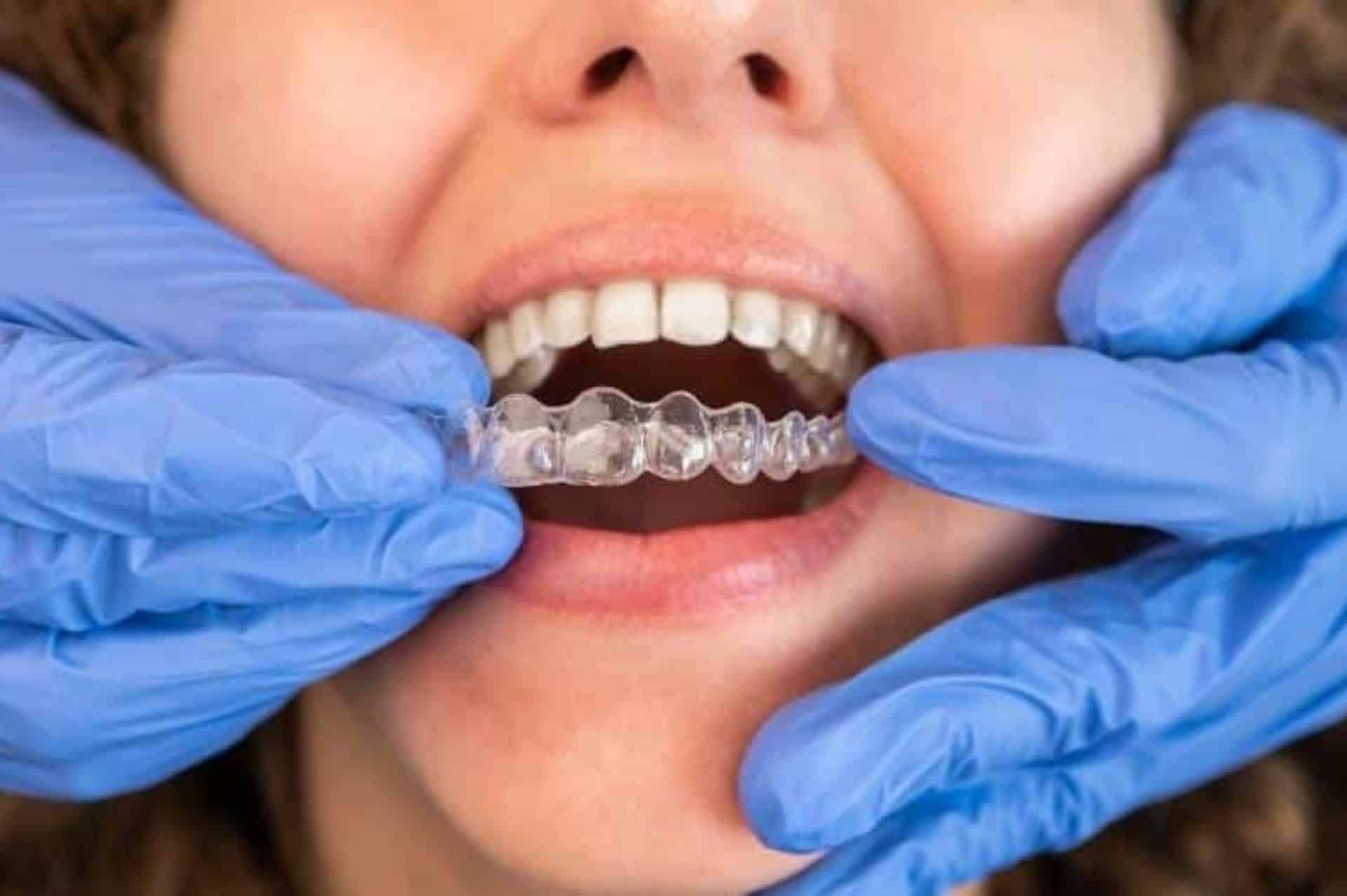 invisalign