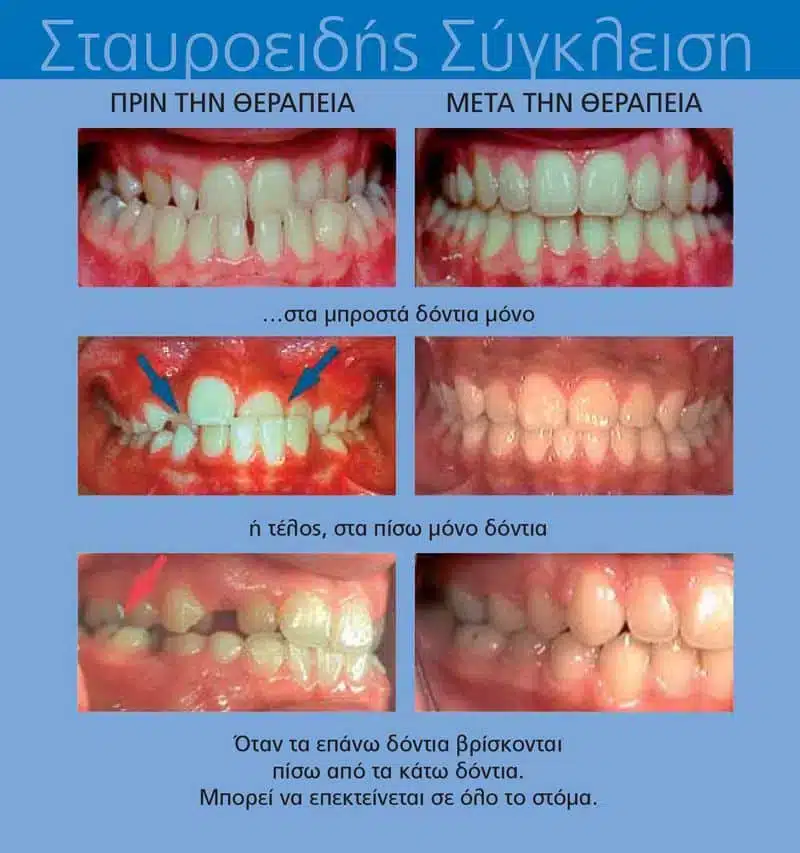 σταυροειδής σύγκλειση δοντιών